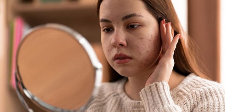 Adult-Onset Acne