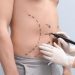 Liposuction